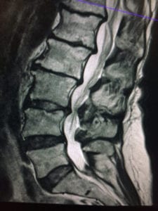 Degenerative Disc Disease Lumbar MRI