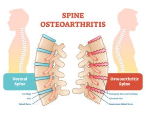 Spine Osteoarthritis - Disc Disease