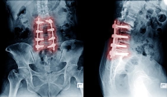 Post Laminectomy Syndrome OKC