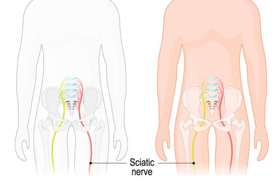 Sciatica, Lower Back Pain & the Sciatic Nerve